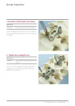 Preview for 7 page of Johnson & Johnson DePuy Synthes CSLP Manual