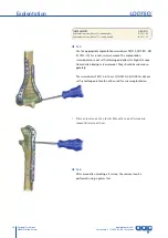 Preview for 28 page of AAP LOQTEQ Distal Dorsolateral Humerus Plate... Manual