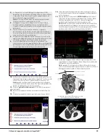 Preview for 51 page of Abiomed Impella LD User Manual