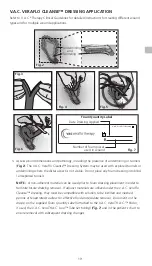 Preview for 19 page of Acelity V.A.C. Ulta Therapy System Safety Information And Instructions