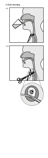 Preview for 5 page of Atos Medical Provox Vega XtraSeal Clinician Manual