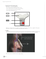 Preview for 15 page of Bard Sherlock 3CG TCS Instructions For Use Manual