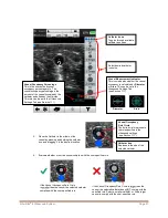 Preview for 23 page of Bard Site-Rite 8 Instructions For Use Manual