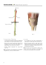 Предварительный просмотр 8 страницы BIOMET VANGUARD XP Manual