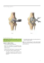 Предварительный просмотр 9 страницы BIOMET VANGUARD XP Manual