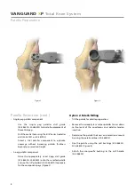 Предварительный просмотр 10 страницы BIOMET VANGUARD XP Manual