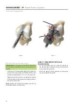 Предварительный просмотр 12 страницы BIOMET VANGUARD XP Manual