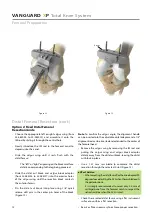 Предварительный просмотр 14 страницы BIOMET VANGUARD XP Manual