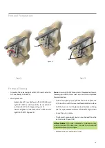 Предварительный просмотр 15 страницы BIOMET VANGUARD XP Manual