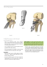 Предварительный просмотр 17 страницы BIOMET VANGUARD XP Manual