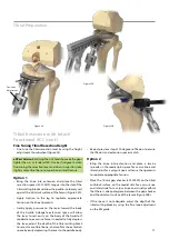 Предварительный просмотр 19 страницы BIOMET VANGUARD XP Manual