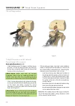 Предварительный просмотр 22 страницы BIOMET VANGUARD XP Manual