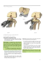 Предварительный просмотр 23 страницы BIOMET VANGUARD XP Manual