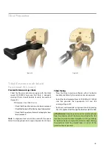 Предварительный просмотр 25 страницы BIOMET VANGUARD XP Manual