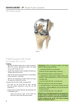 Предварительный просмотр 26 страницы BIOMET VANGUARD XP Manual