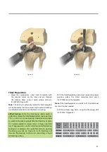 Предварительный просмотр 27 страницы BIOMET VANGUARD XP Manual