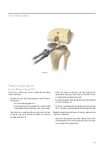 Предварительный просмотр 31 страницы BIOMET VANGUARD XP Manual