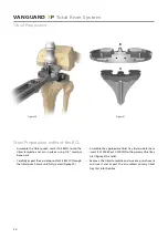 Предварительный просмотр 32 страницы BIOMET VANGUARD XP Manual