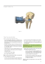 Предварительный просмотр 33 страницы BIOMET VANGUARD XP Manual