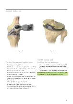 Предварительный просмотр 37 страницы BIOMET VANGUARD XP Manual