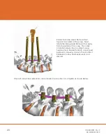 Preview for 20 page of CAMBER ORTHROS MIS Surgical Technique Manual