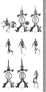 Preview for 15 page of COOK Medical Zenith Flex Series Instructions For Use Manual