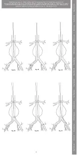 Preview for 21 page of COOK Medical Zenith Flex Series Instructions For Use Manual