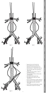 Предварительный просмотр 15 страницы COOK Medical Zenith Spiral-Z AAA Instructions For Use Manual