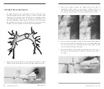 Предварительный просмотр 15 страницы Endotronix Cordella Instructions For Use Manual