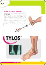 Preview for 7 page of FH ORTHOPEDICS be POD TYLOS Arthrodese-Nail Manual