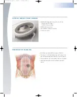 Preview for 4 page of Johnson & Johnson Codman MedStream Surgical Technique Manual