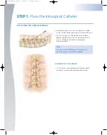 Preview for 6 page of Johnson & Johnson Codman MedStream Surgical Technique Manual