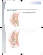 Preview for 8 page of Johnson & Johnson Codman MedStream Surgical Technique Manual