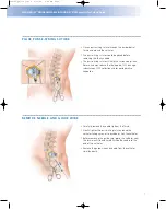 Preview for 9 page of Johnson & Johnson Codman MedStream Surgical Technique Manual