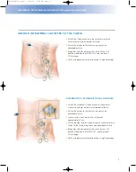 Preview for 11 page of Johnson & Johnson Codman MedStream Surgical Technique Manual