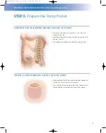 Preview for 13 page of Johnson & Johnson Codman MedStream Surgical Technique Manual