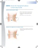 Preview for 14 page of Johnson & Johnson Codman MedStream Surgical Technique Manual