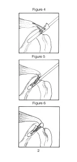 Preview for 3 page of Johnson & Johnson DePuy Mitek BIOKNOTLESS RC ANCHOR Manual