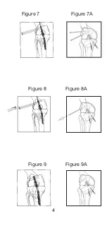 Preview for 5 page of Johnson & Johnson DePuy Mitek Rigidfix 104144 Manual