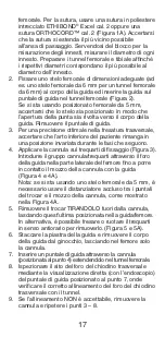 Preview for 18 page of Johnson & Johnson DePuy Mitek Rigidfix 104144 Manual