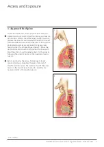 Preview for 11 page of Johnson & Johnson DePuy Synthes INSIGHT Lateral Access System Manual