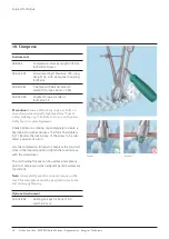 Preview for 28 page of Johnson & Johnson DePuy Synthes MATRIX Surgical Technique