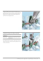 Preview for 37 page of Johnson & Johnson DePuy Synthes MATRIX Surgical Technique