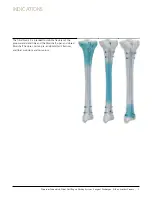 Preview for 6 page of Johnson & Johnson DePuy Synthes TRAUMA Titanium Cannulated Tibial Nail Surgical Technique