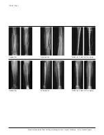 Preview for 8 page of Johnson & Johnson DePuy Synthes TRAUMA Titanium Cannulated Tibial Nail Surgical Technique