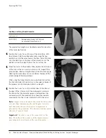 Preview for 11 page of Johnson & Johnson DePuy Synthes TRAUMA Titanium Cannulated Tibial Nail Surgical Technique