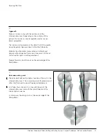 Preview for 12 page of Johnson & Johnson DePuy Synthes TRAUMA Titanium Cannulated Tibial Nail Surgical Technique