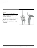 Preview for 13 page of Johnson & Johnson DePuy Synthes TRAUMA Titanium Cannulated Tibial Nail Surgical Technique