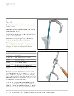 Preview for 17 page of Johnson & Johnson DePuy Synthes TRAUMA Titanium Cannulated Tibial Nail Surgical Technique