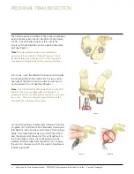 Preview for 4 page of Johnson & Johnson Depuy Synthes Trumatch Surgical Technique